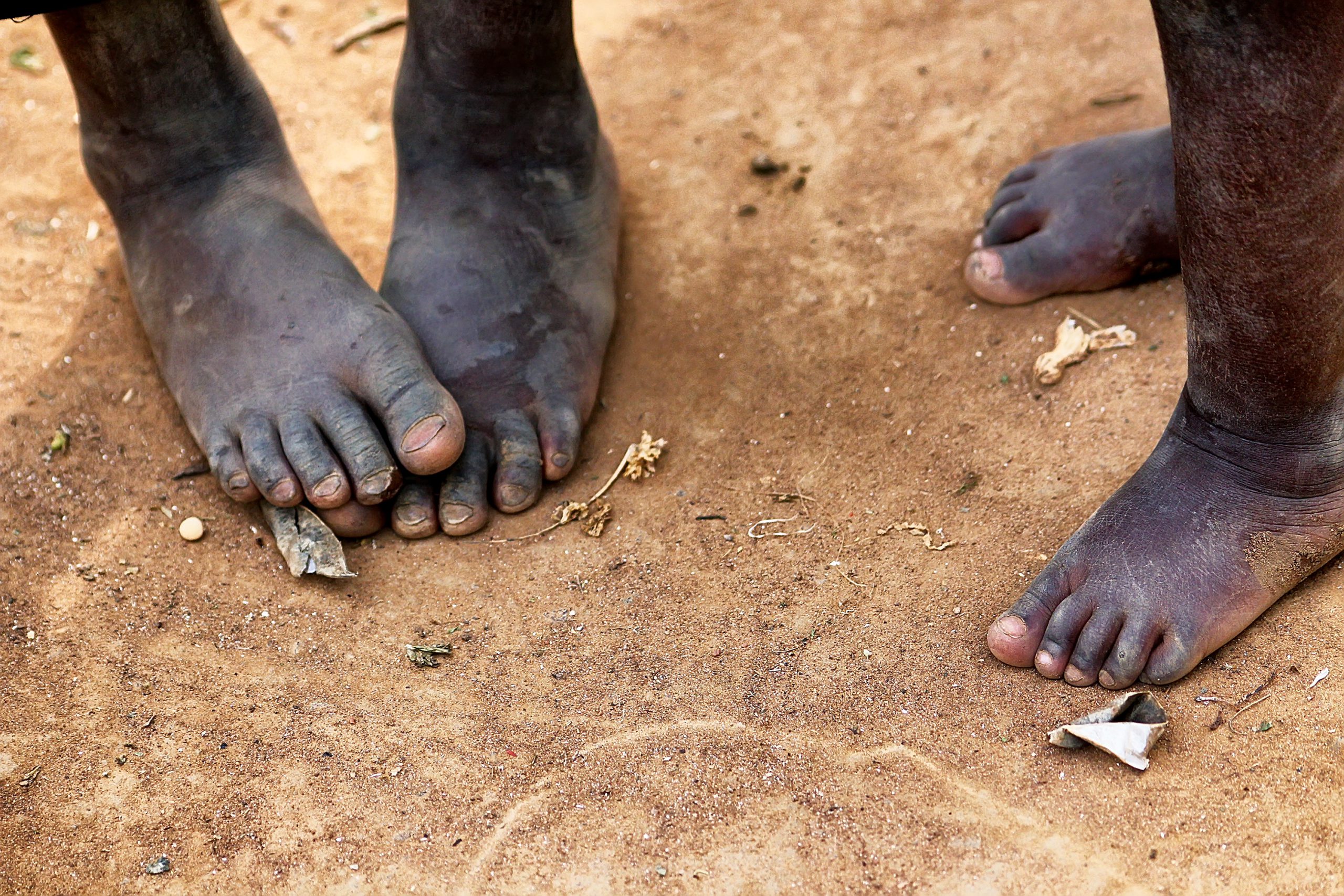 Feet of poor African children